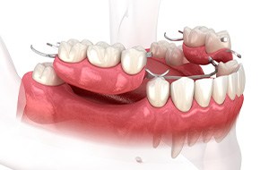 3D render of partial dentures